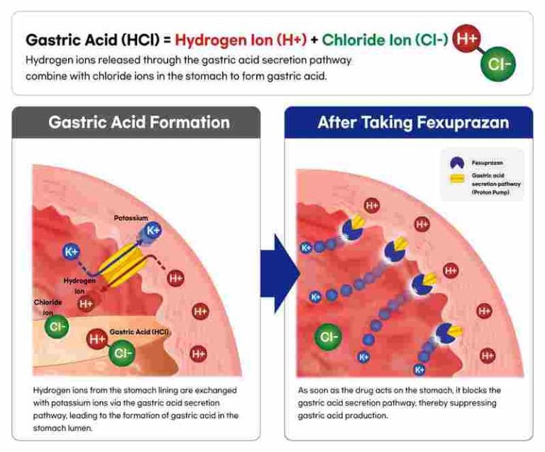 Fexuprazan Menarik Perhatian Berkat Kemampuan Meredakan Gerd Secara Cepat & juga Efektif di Malam Hari
